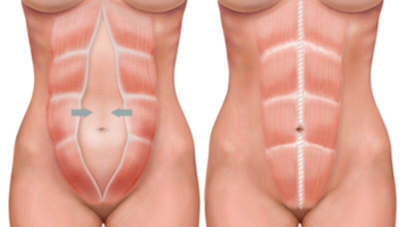 Diástasis abdominal o separación de los músculos rectos del abdomen
