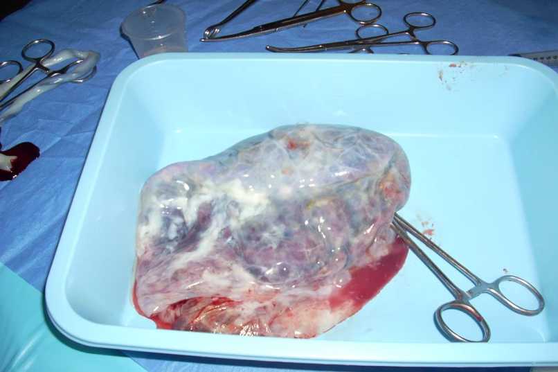 Il bambino è circondato dalla placenta, dal cordone ombelicale, dal sacco amniotico e dal liquido amniotico.